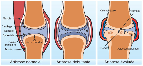 Arthrose du genou, que peut faire l'ostéopathie ?